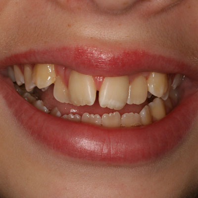 before